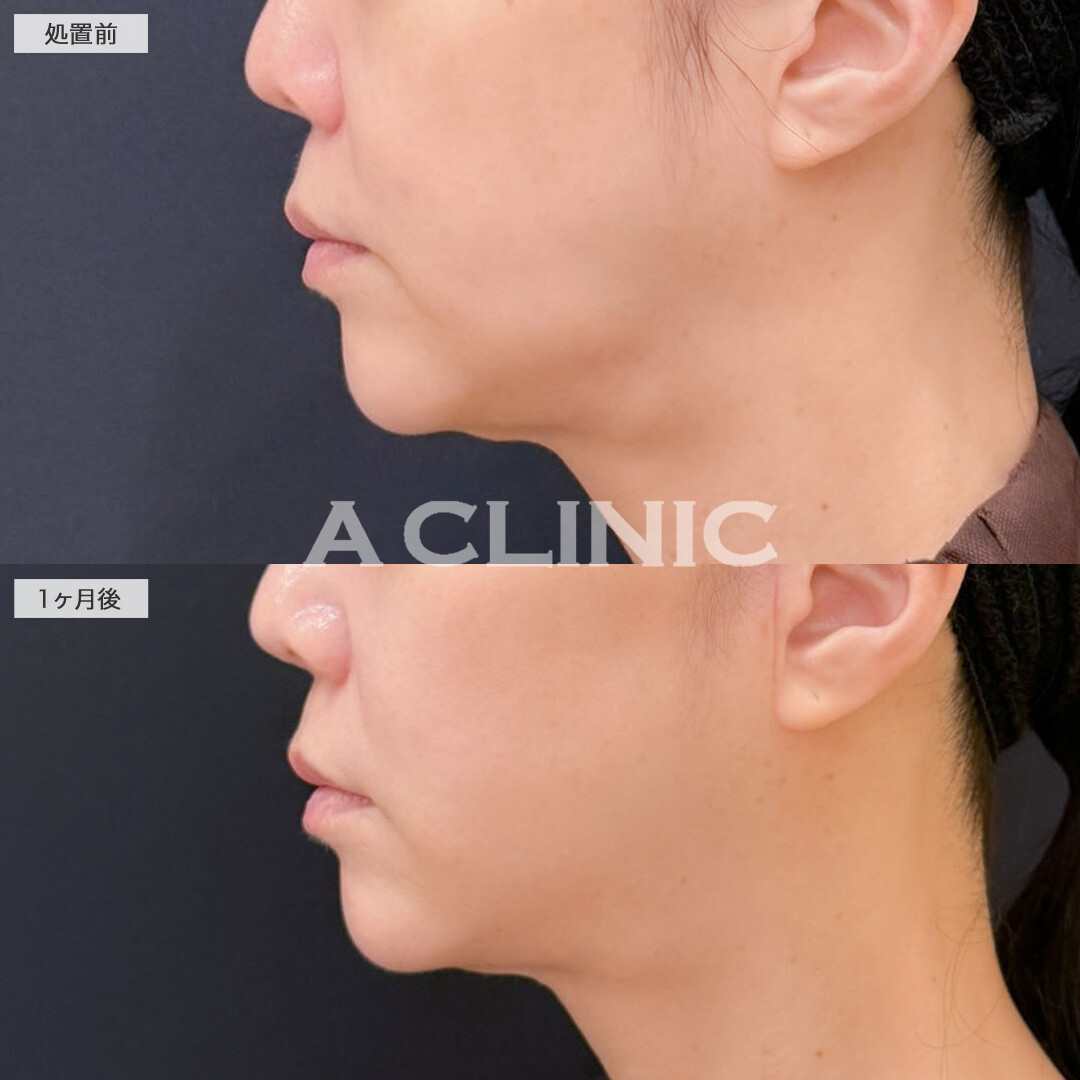 ナゾラビアルファット除去術とA式美肌たるみ切開でほうれい線を薄くすることができました!こちら処置前と1ヶ月後の症例です(40代女性)