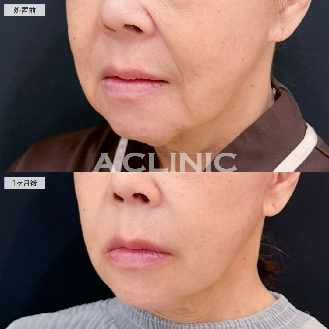 A式美肌たるみ切開と1day小顔脂肪吸引でたるみと下膨れを解消！こちら処置前と1ヶ月後の症例です(60代女性)