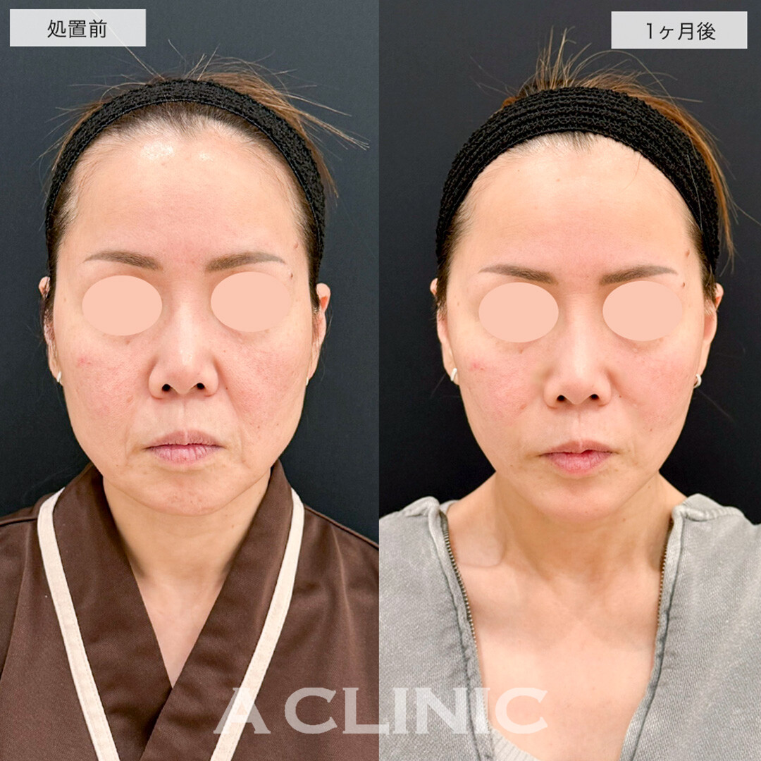 A式美肌たるみ切開と1day小顔脂肪吸引の組み合わせでたるみとほうれい線が改善しました!こちら処置前と1ヶ月後の症例です(40代女性)