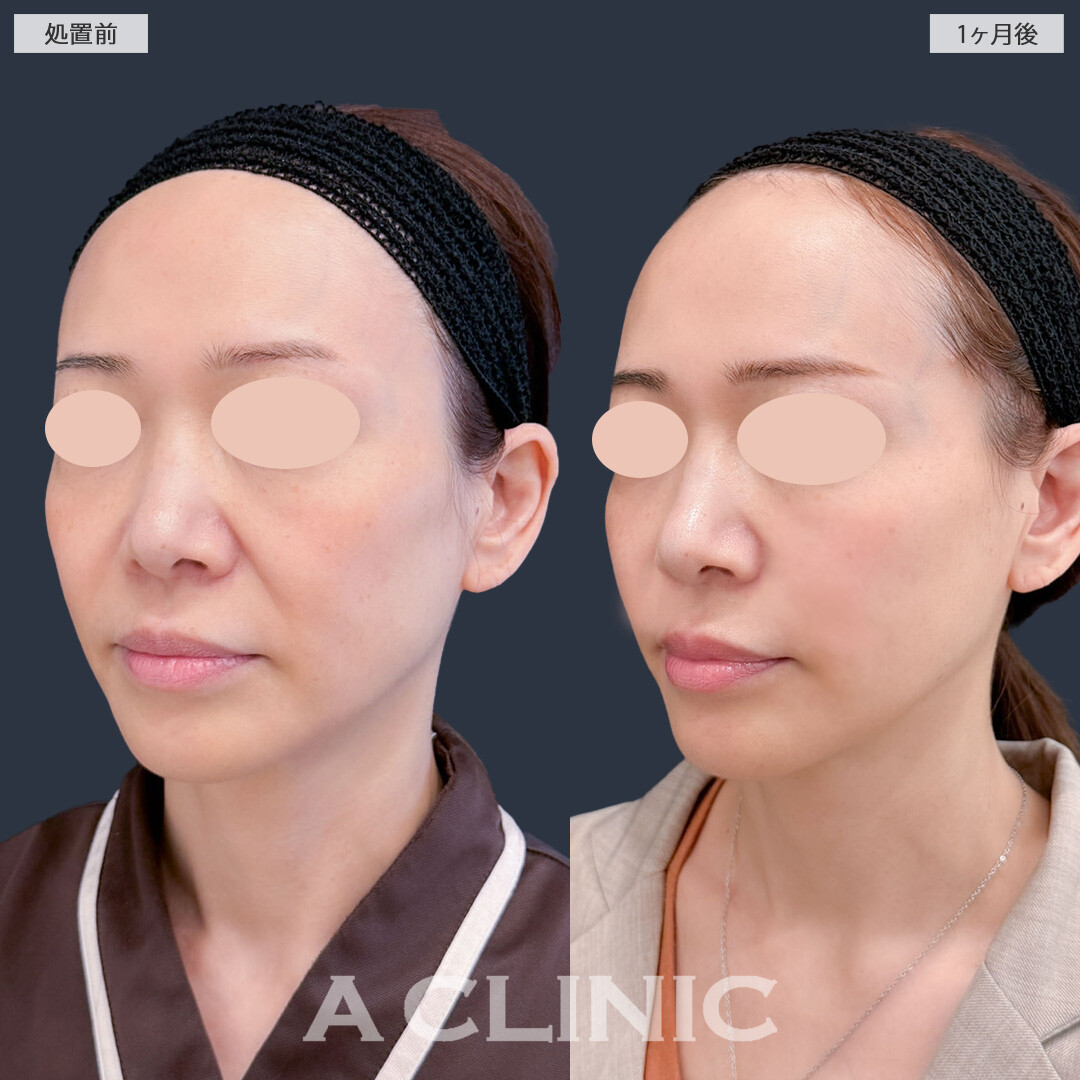 A式ナゾラリフトでほうれい線を改善して若返り！こちら処置前と1ヶ月後の症例です(40代女性)
