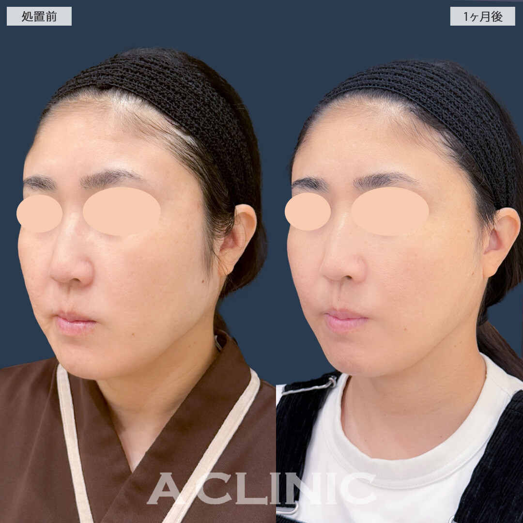 1day小顔脂肪吸引とA式美肌たるみ切開は併用することで脂肪を取ってたるみをしっかり引き上げます！こちら処置前と1ヶ月後の症例です(40代女性)