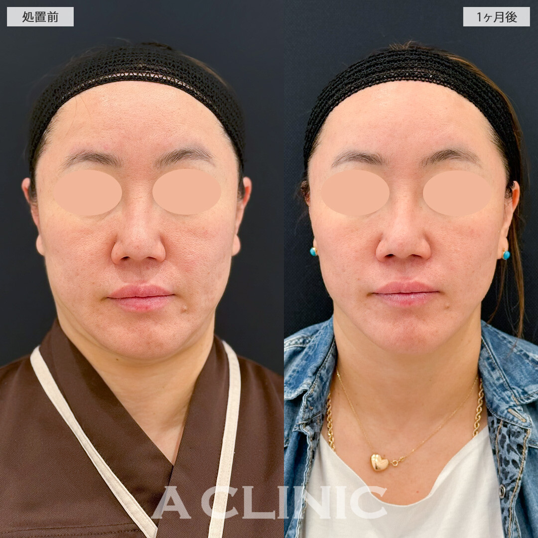 A式美肌たるみ切開で皮膚のたるみ解消で輪郭もスッキリ！処置前と1ヶ月後の症例です(40代女性)