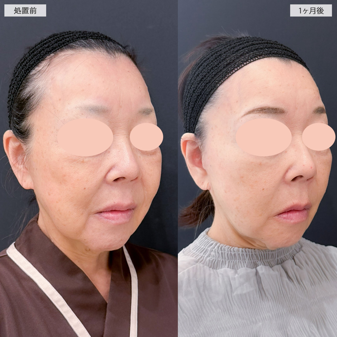 A式美肌たるみ切開と1day小顔脂肪吸引でたるみと下膨れを解消！こちら処置前と1ヶ月後の症例です(60代女性)