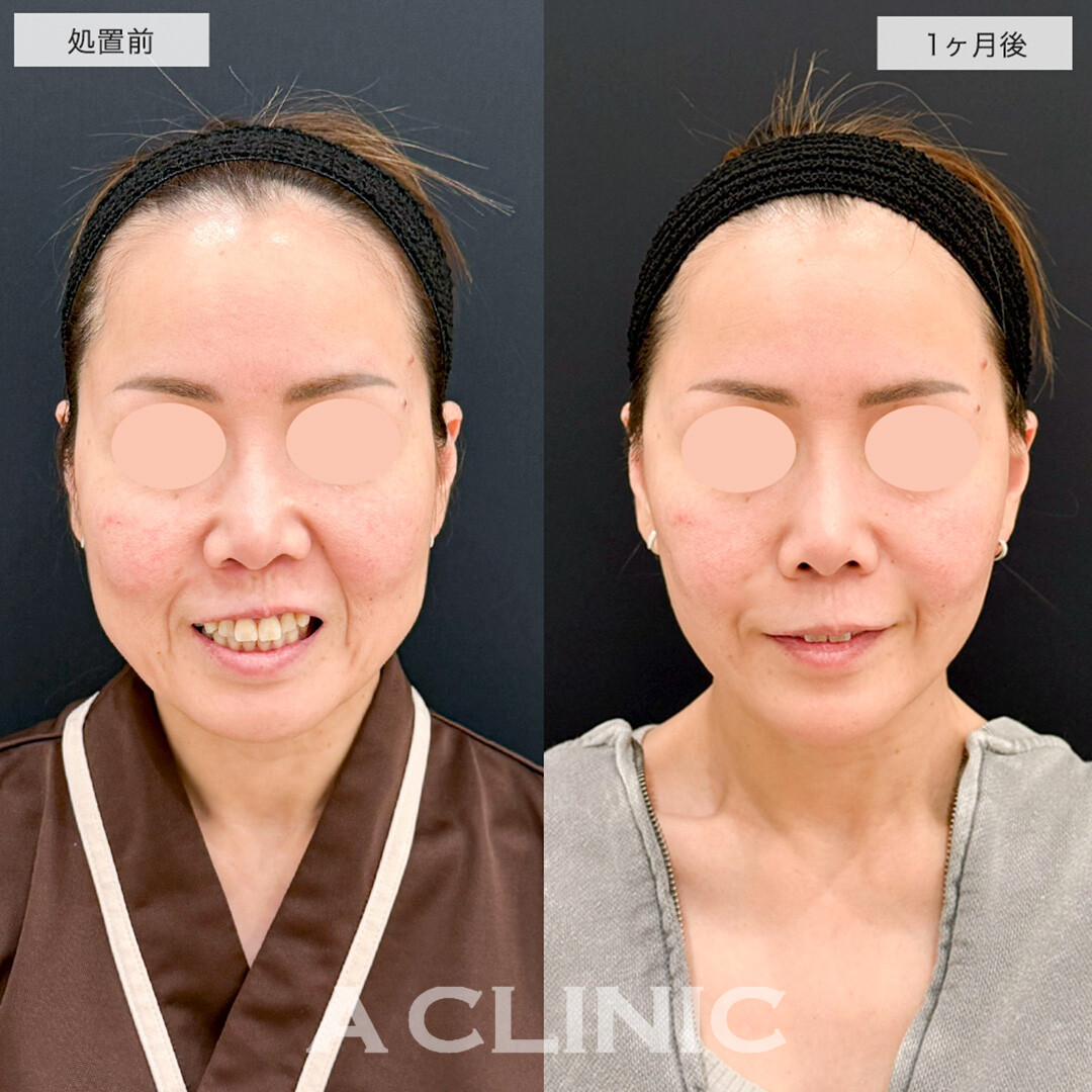 A式美肌たるみ切開と1day小顔脂肪吸引の組み合わせでたるみとほうれい線が改善しました!こちら処置前と1ヶ月後の症例です(40代女性)
