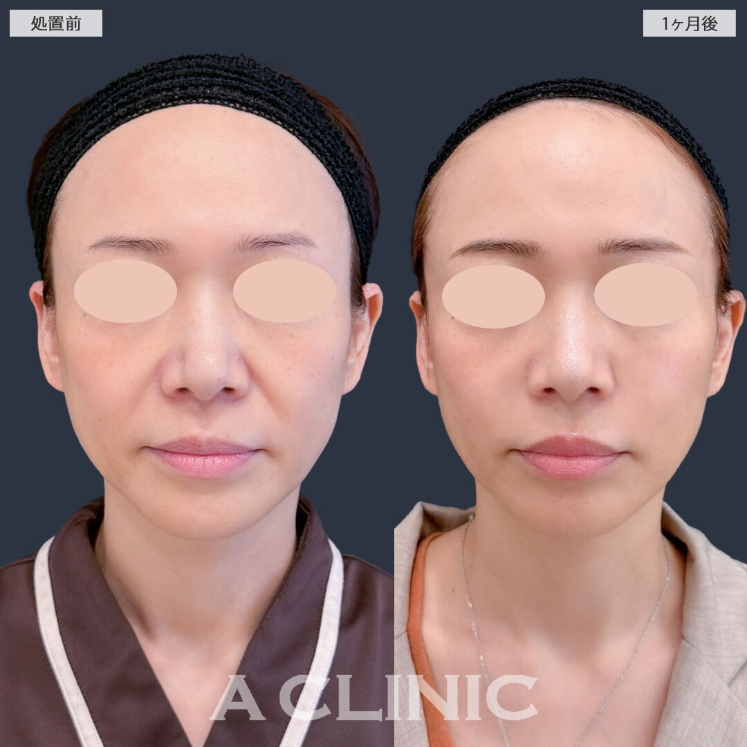 A式ナゾラリフトでほうれい線を改善して若返り！こちら処置前と1ヶ月後の症例です(40代女性)
