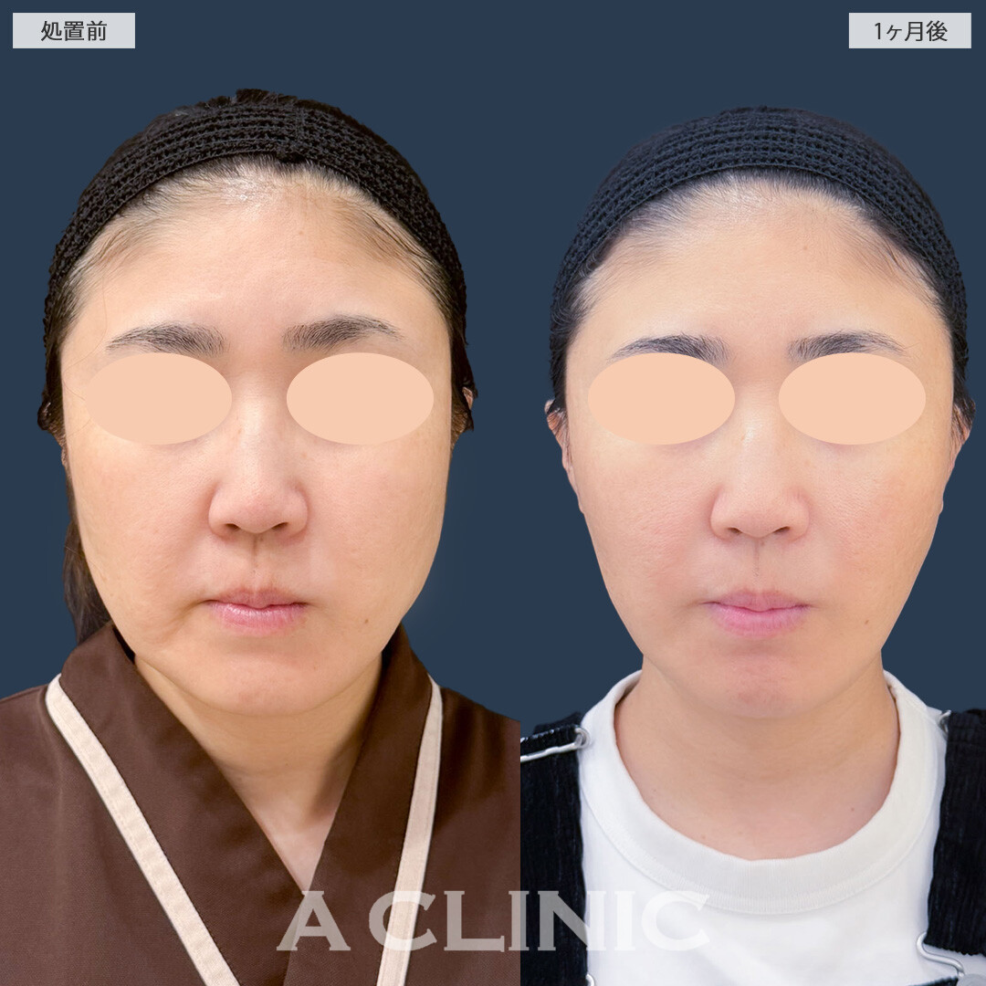 1day小顔脂肪吸引とA式美肌たるみ切開は併用することで脂肪を取ってたるみをしっかり引き上げます！こちら処置前と1ヶ月後の症例です(40代女性)