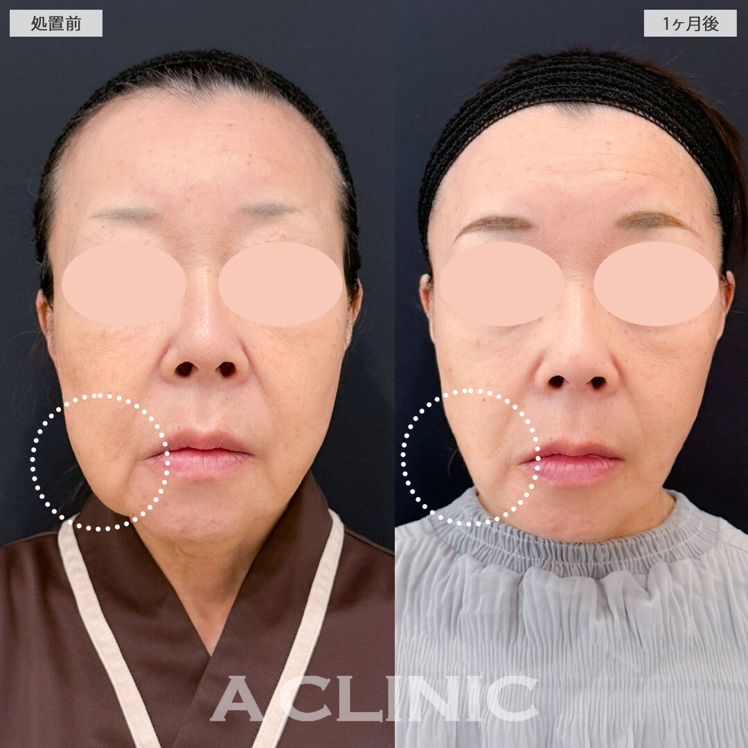 A式美肌たるみ切開と1day小顔脂肪吸引でたるみと下膨れを解消！こちら処置前と1ヶ月後の症例です(60代女性)