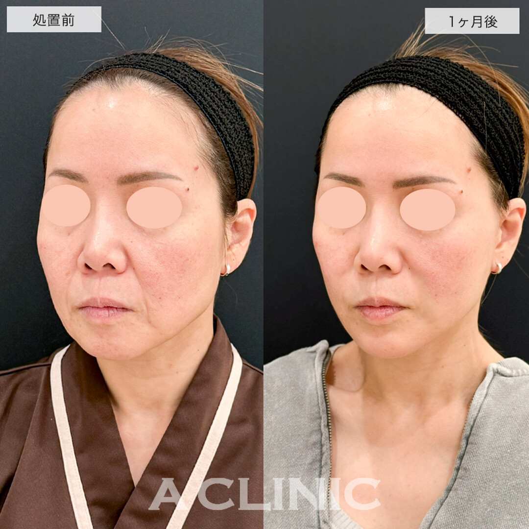 A式美肌たるみ切開と1day小顔脂肪吸引の組み合わせでたるみとほうれい線が改善しました!こちら処置前と1ヶ月後の症例です(40代女性)