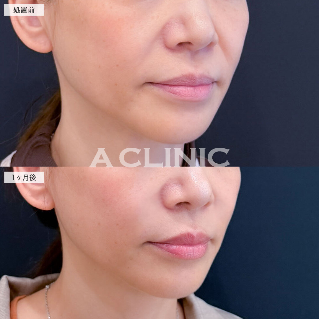 A式ナゾラリフトでほうれい線を改善して若返り！こちら処置前と1ヶ月後の症例です(40代女性)