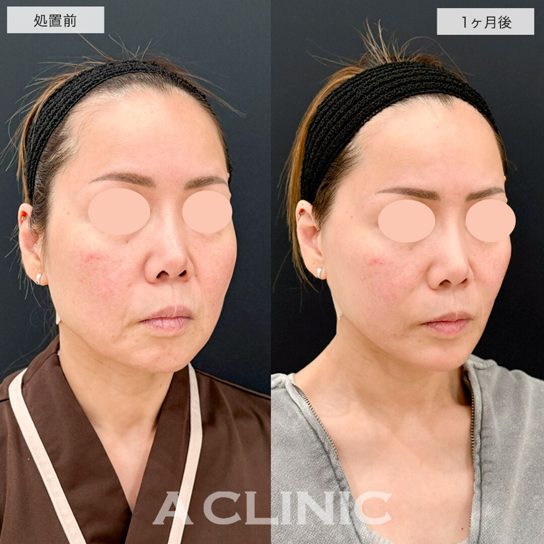 A式美肌たるみ切開と1day小顔脂肪吸引の組み合わせでたるみとほうれい線が改善しました!こちら処置前と1ヶ月後の症例です(40代女性)