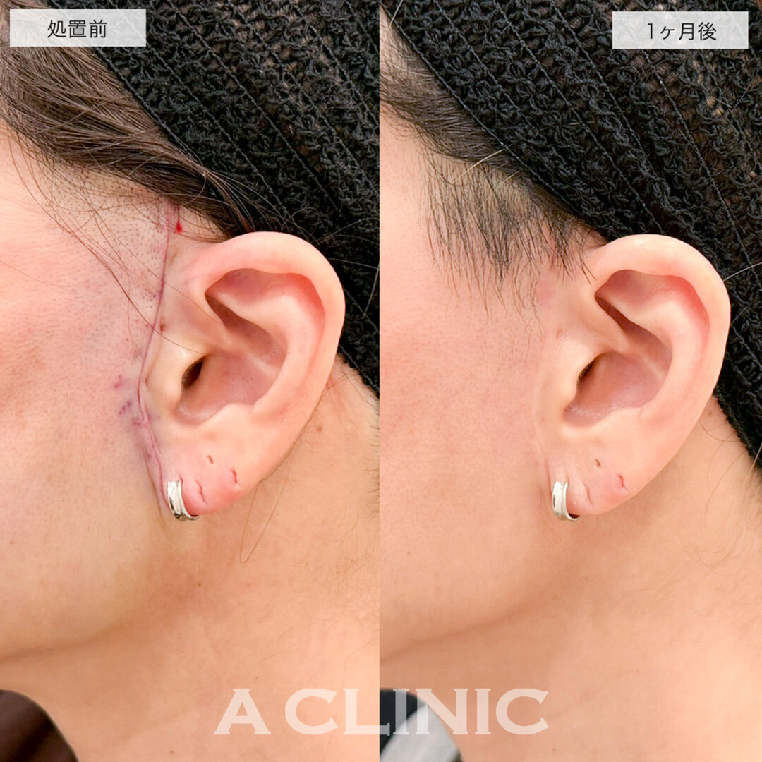 A式美肌たるみ切開と1day小顔脂肪吸引の組み合わせでたるみとほうれい線が改善しました!こちら処置前と1ヶ月後の症例です(40代女性)