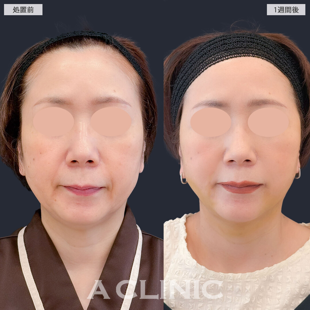 A式美肌たるみ切開と1day小顔脂肪吸引で老け見えの原因であるたるみを改善できます!こちら処置前と1週間後の症例です(50代女性)