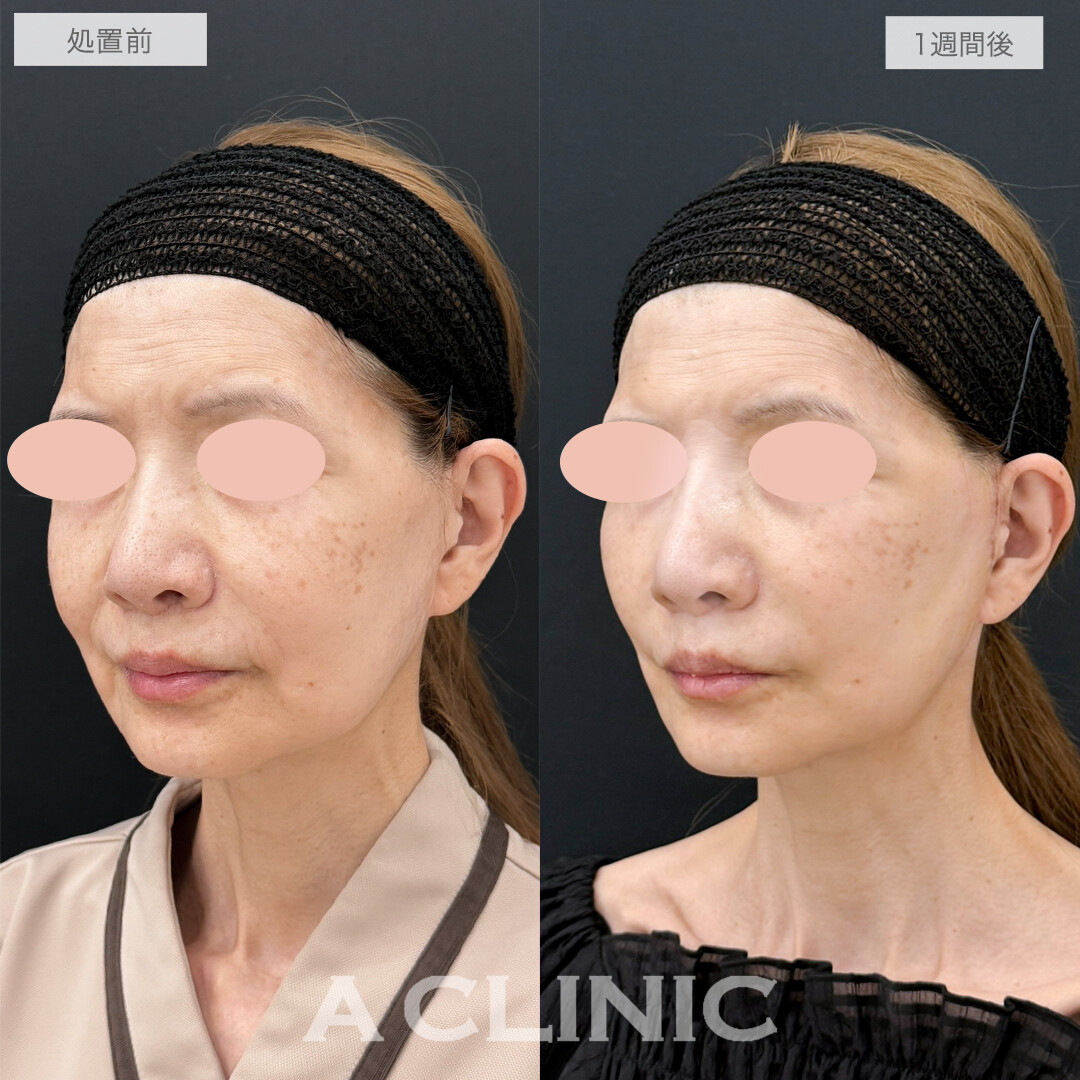 A式美肌たるみ切開でたるみが消えて若返り！処置前と1週間後の症例です(50代女性)