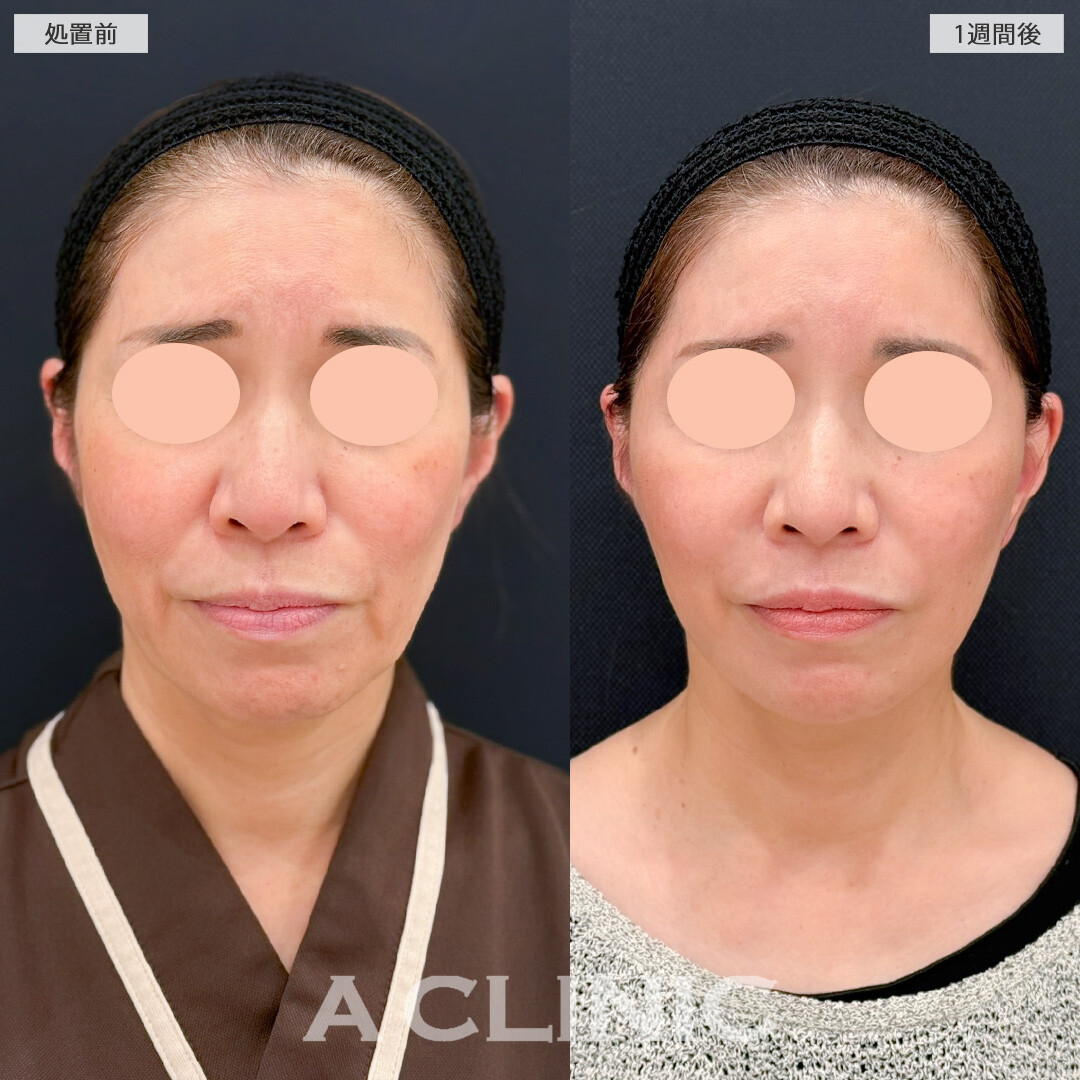 A式美肌たるみ切開でフェイスラインのたるみとほうれい線が目立たなくなりました！処置前と1週間後の症例です(50代女性)