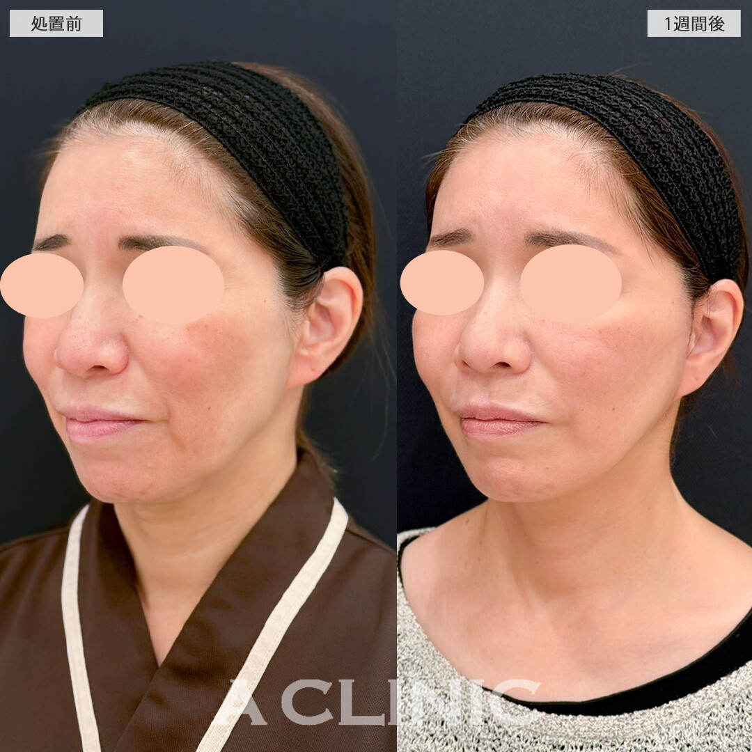 A式美肌たるみ切開でフェイスラインのたるみとほうれい線が目立たなくなりました！処置前と1週間後の症例です(50代女性)
