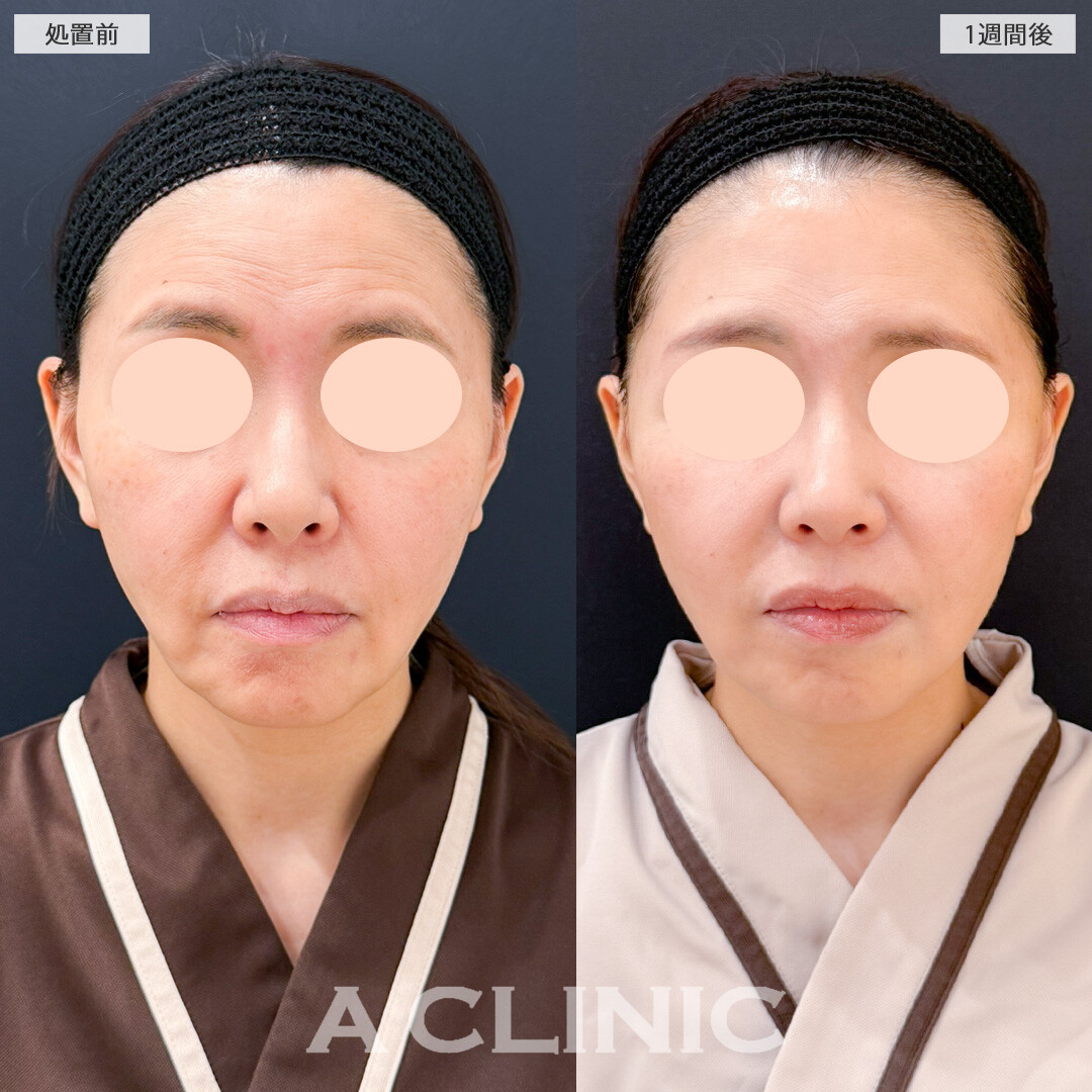 A式美肌たるみ切開でフェイスラインのもたつきがスッキリしてたるみが目立たなくなりました！処置前と1週間後の症例です(50代女性)