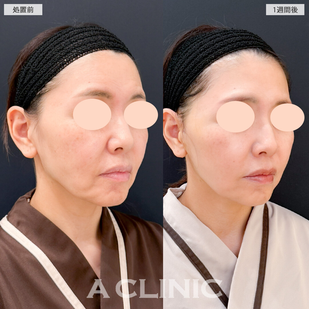 A式美肌たるみ切開でフェイスラインのもたつきがスッキリしてたるみが目立たなくなりました！処置前と1週間後の症例です(50代女性)