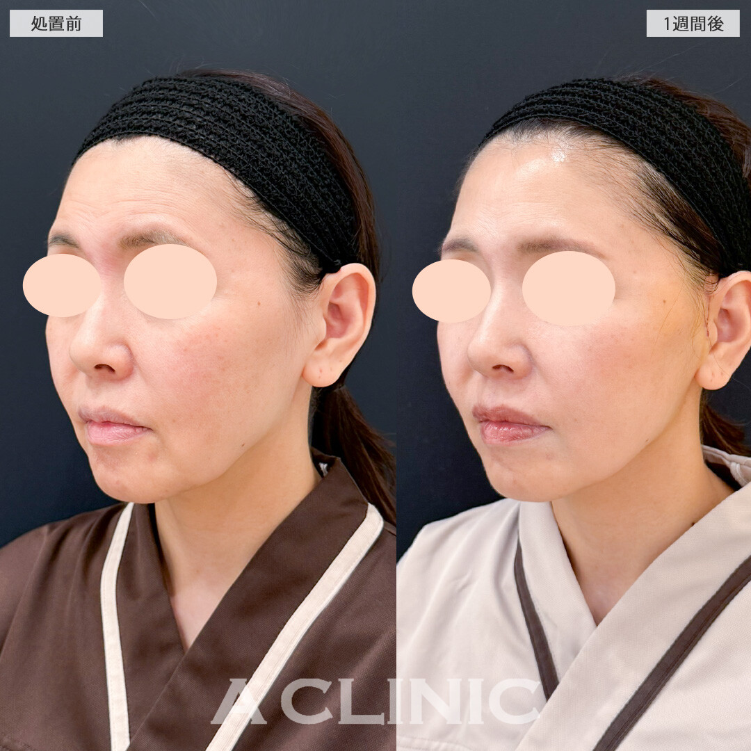 A式美肌たるみ切開でフェイスラインのもたつきがスッキリしてたるみが目立たなくなりました！処置前と1週間後の症例です(50代女性)