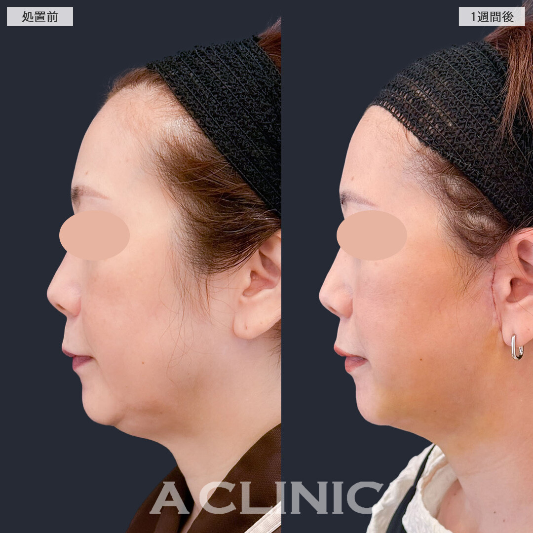 A式美肌たるみ切開と1day小顔脂肪吸引で老け見えの原因であるたるみを改善できます!こちら処置前と1週間後の症例です(50代女性)