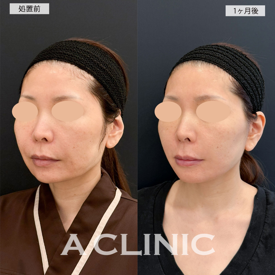 A式美肌たるみ切開でほうれい線のシワが緩和され若返り!こちら処置前と1ヶ月後の症例です(40代女性)