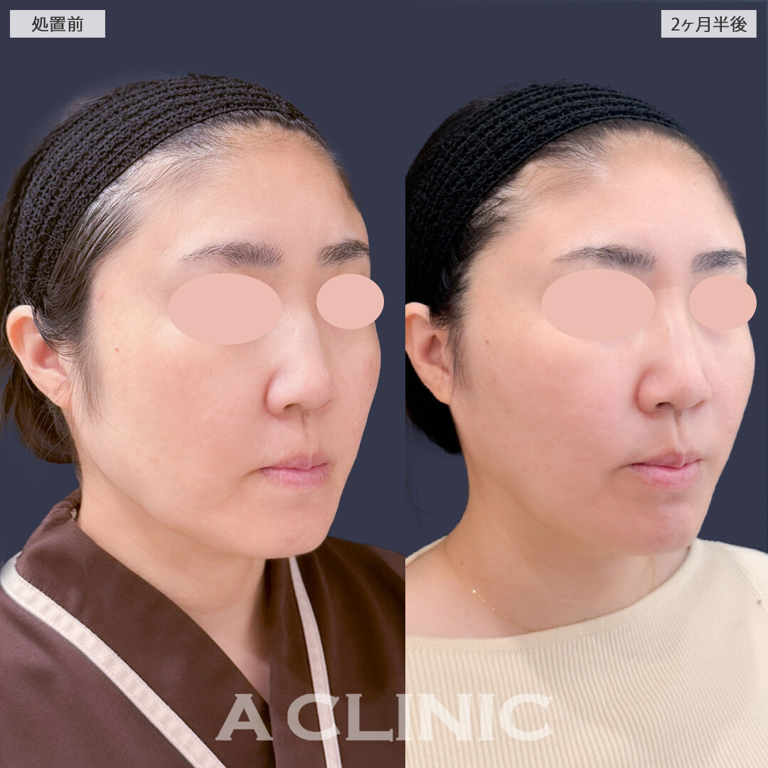 1day小顔脂肪吸引とA式美肌たるみ切開で余白を無くしてスッキリ小顔に！こちら処置前と2ヶ月半後の症例です(40代女性)