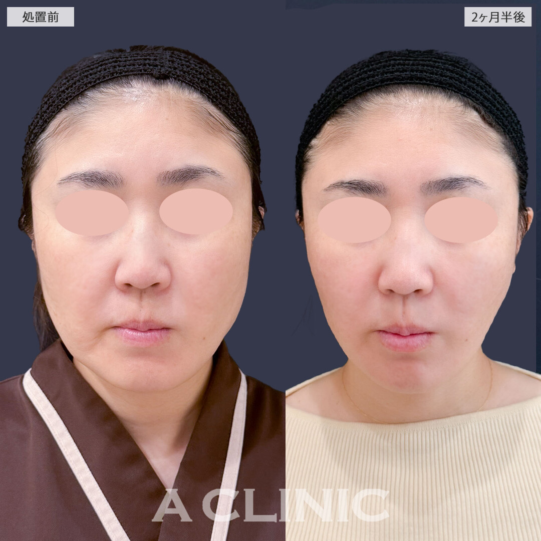 1day小顔脂肪吸引とA式美肌たるみ切開で余白を無くしてスッキリ小顔に！こちら処置前と2ヶ月半後の症例です(40代女性)