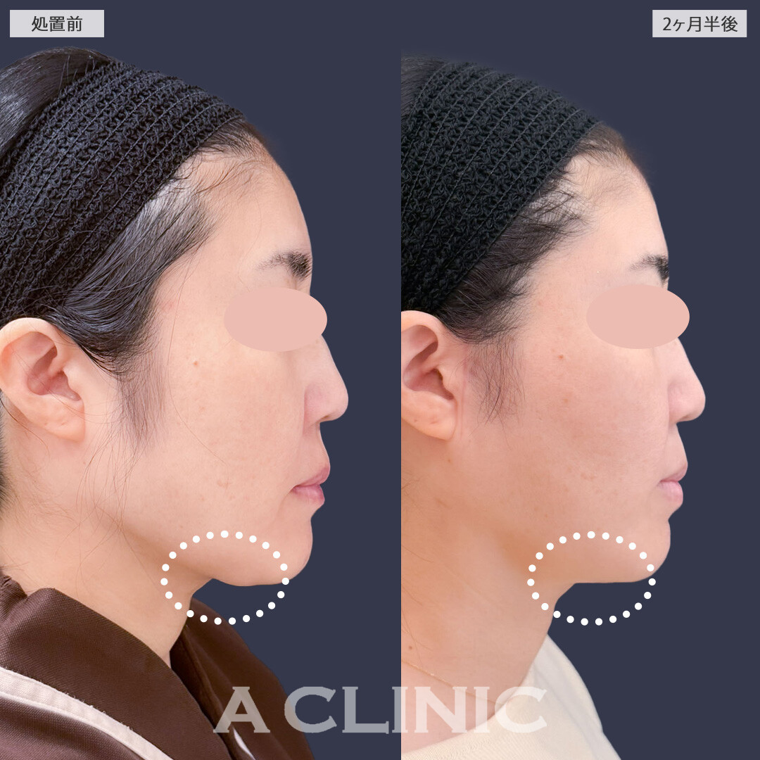 1day小顔脂肪吸引とA式美肌たるみ切開で余白を無くしてスッキリ小顔に！こちら処置前と2ヶ月半後の症例です(40代女性)