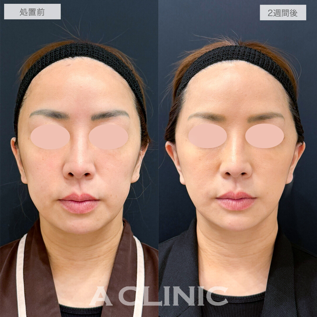 A式美肌たるみ切開でシャープなくっきりフェイスライン！処置前と2週間後の症例です(40代女性)