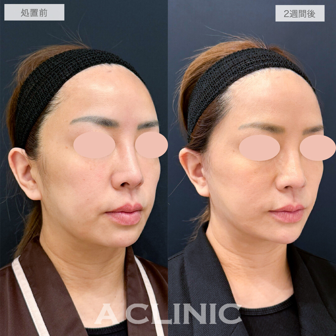 A式美肌たるみ切開でシャープなくっきりフェイスライン！処置前と2週間後の症例です(40代女性)