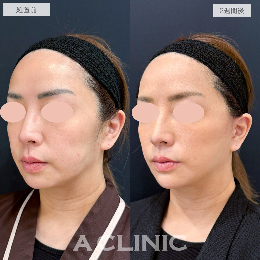 A式美肌たるみ切開でシャープなくっきりフェイスライン！処置前と2週間後の症例です(40代女性)
