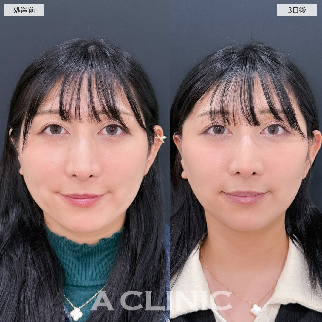 A式美肌たるみ切開でたるみをなくして老け見え防止！こちら処置前と3日後の症例です(30代女性)