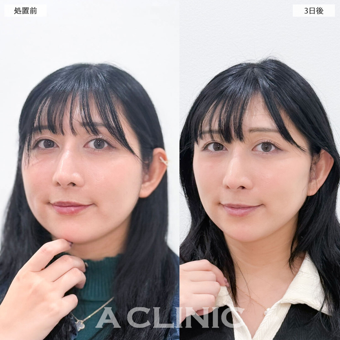 A式美肌たるみ切開でたるみをなくして老け見え防止！こちら処置前と3日後の症例です(30代女性)
