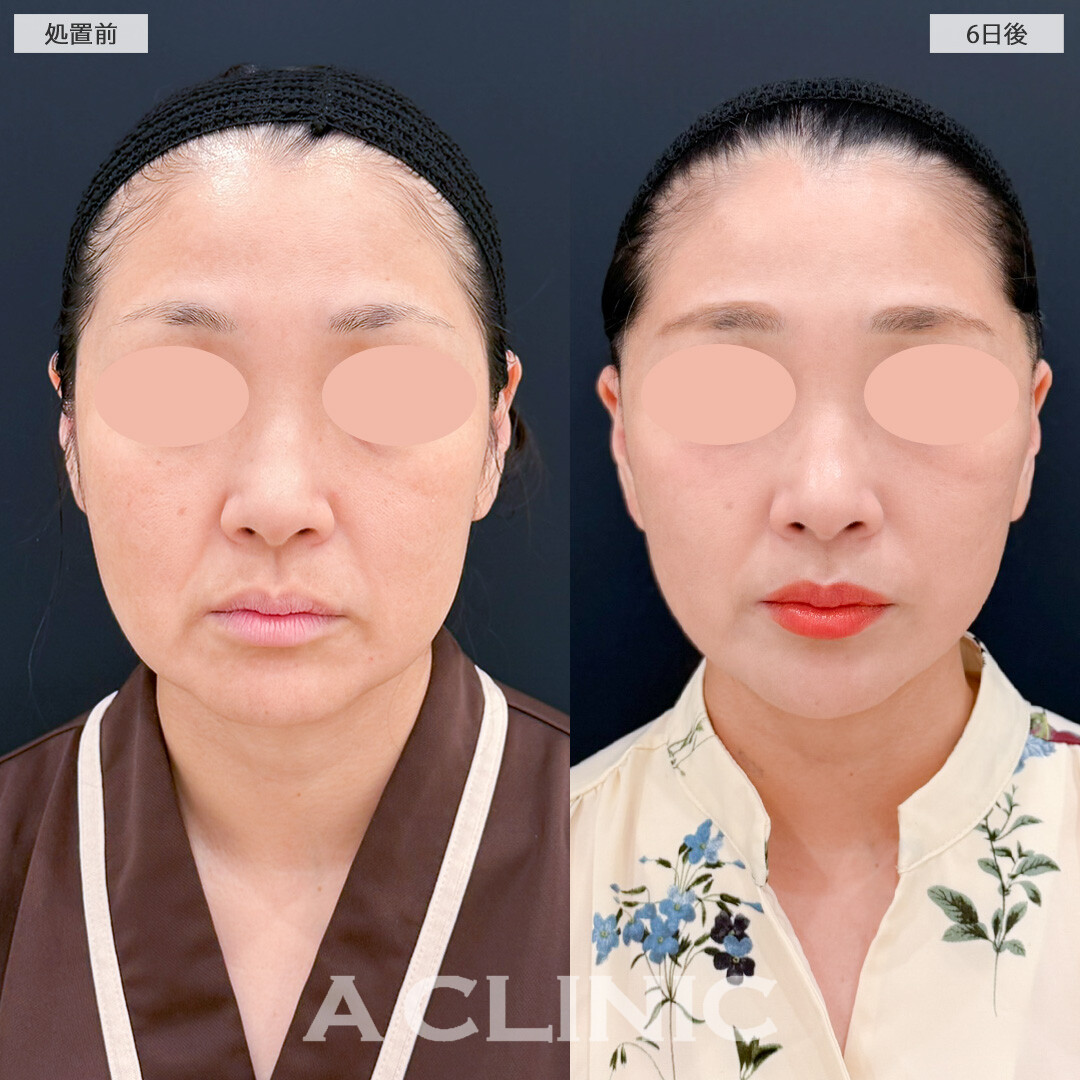 A式美肌たるみ切開で垂れ下がった皮膚もスッキリリフトアップ！処置前と6日後の症例です(40代女性)