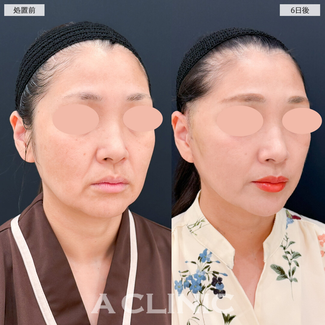 A式美肌たるみ切開で垂れ下がった皮膚もスッキリリフトアップ！処置前と6日後の症例です(40代女性)