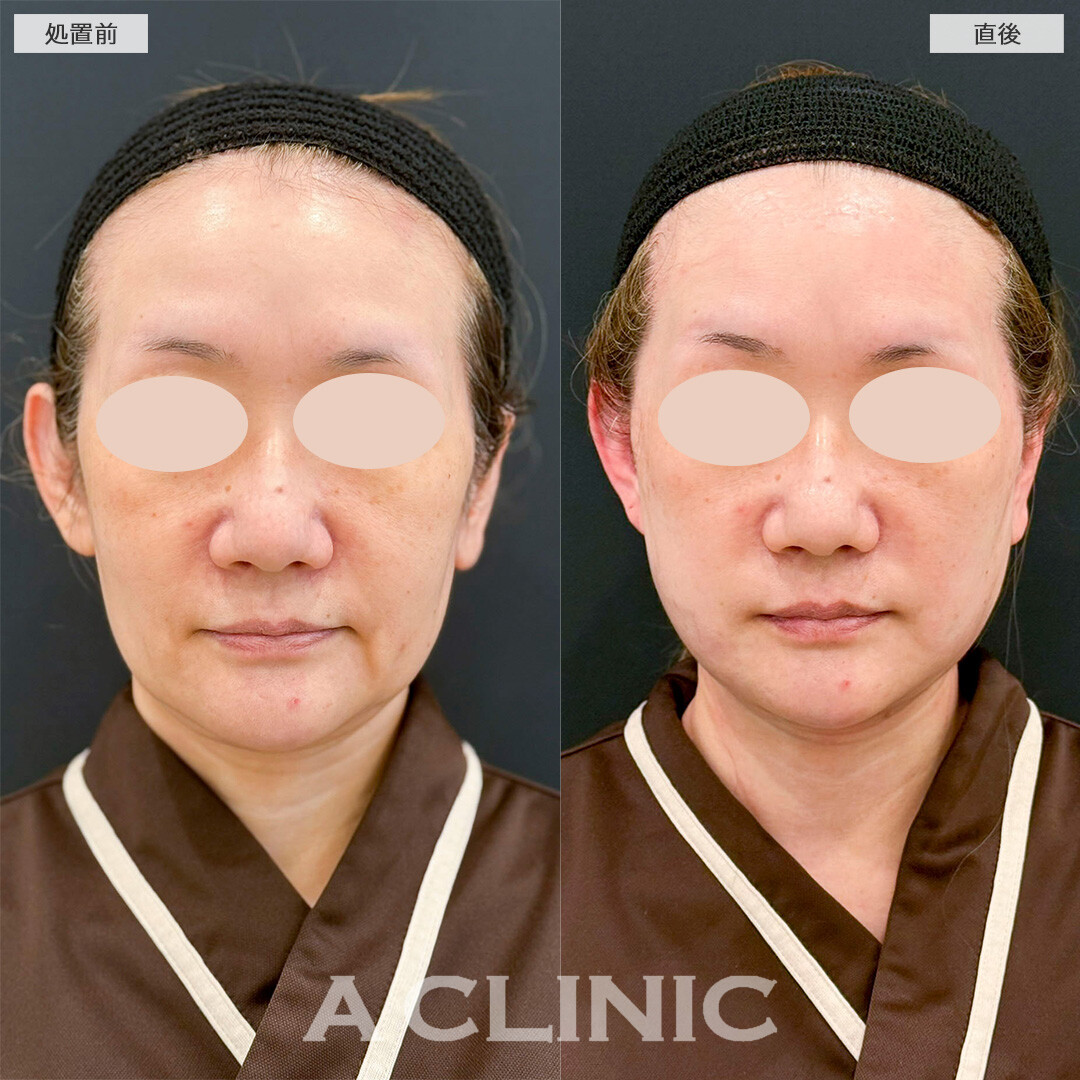 1day小顔脂肪吸引とA式美肌たるみ切開の併用でフェイスラインのたるみを解消！処置前と直後の症例です(50代女性)