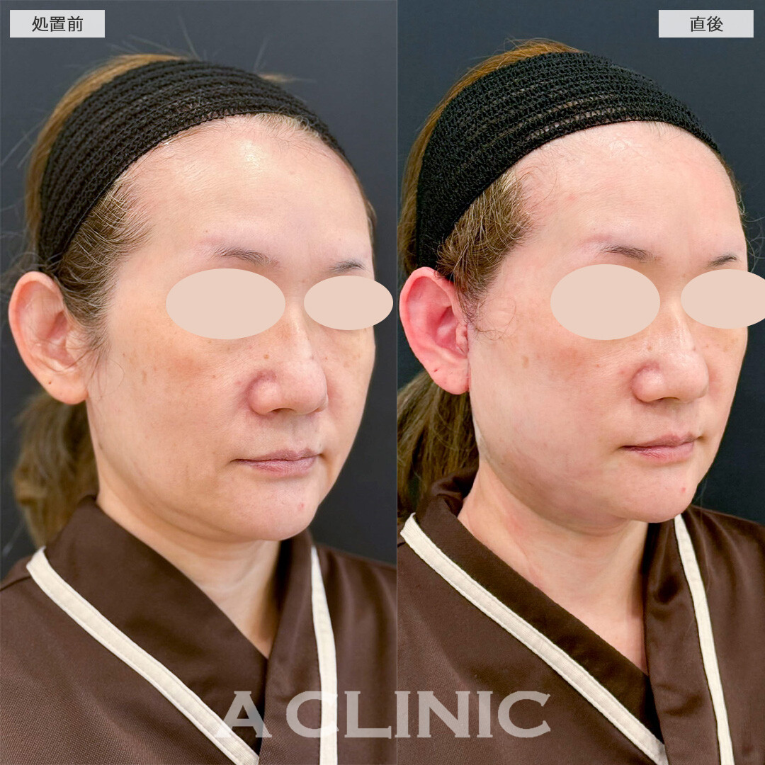1day小顔脂肪吸引とA式美肌たるみ切開の併用でフェイスラインのたるみを解消！処置前と直後の症例です(50代女性)