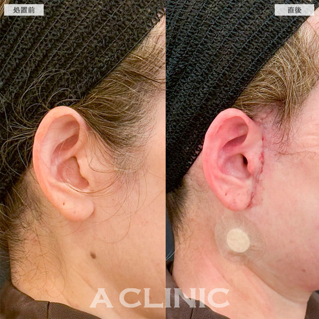 1day小顔脂肪吸引とA式美肌たるみ切開の併用でフェイスラインのたるみを解消！処置前と直後の症例です(50代女性)