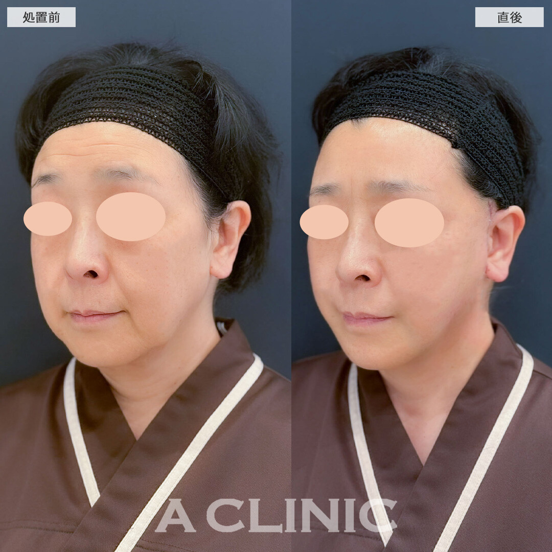 【直後の傷跡あり】A式美肌たるみ切開と1day小顔脂肪吸引で直後からたるみが無くなりました！こちら処置前と直後の症例です(60代女性)