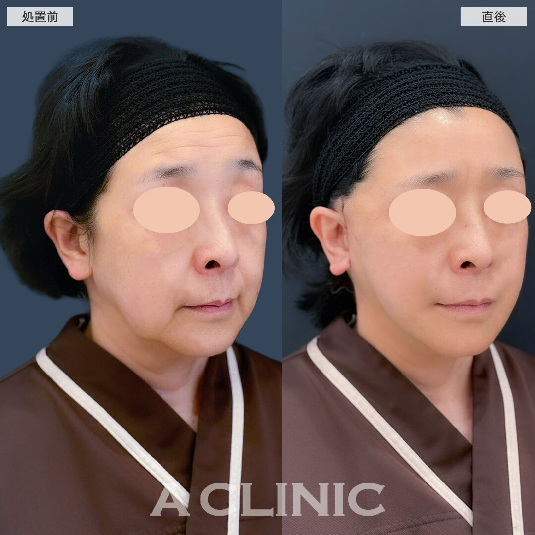 【直後の傷跡あり】A式美肌たるみ切開と1day小顔脂肪吸引で直後からたるみが無くなりました！こちら処置前と直後の症例です(60代女性)