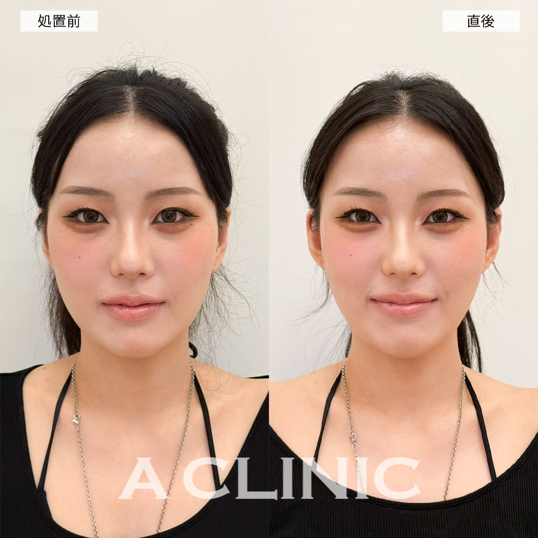 立ち耳ヒアルロン酸(ボリューマ)で直後からワンホン美女に！こちら処置前と直後の症例です(20代女性)
