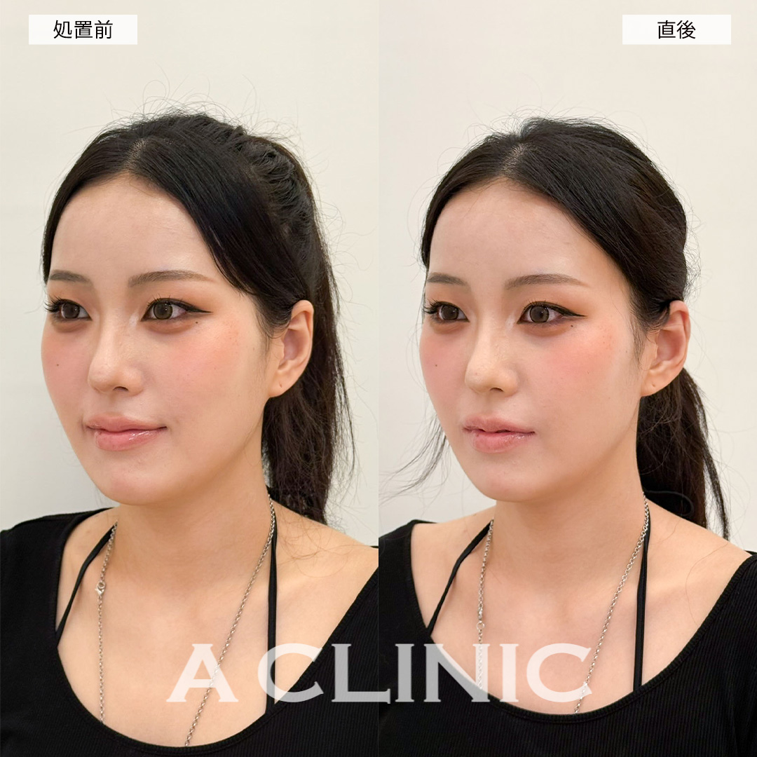 立ち耳ヒアルロン酸(ボリューマ)で直後からワンホン美女に！こちら処置前と直後の症例です(20代女性)