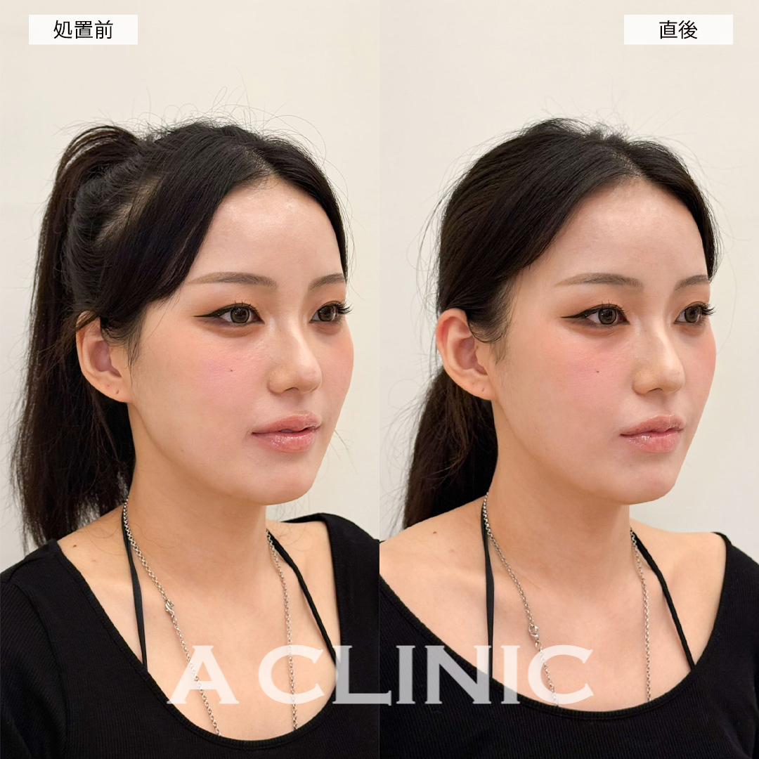立ち耳ヒアルロン酸(ボリューマ)で直後からワンホン美女に！こちら処置前と直後の症例です(20代女性)