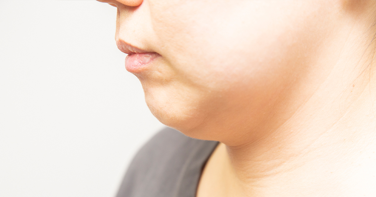 顔に肉がつきやすくなる原因