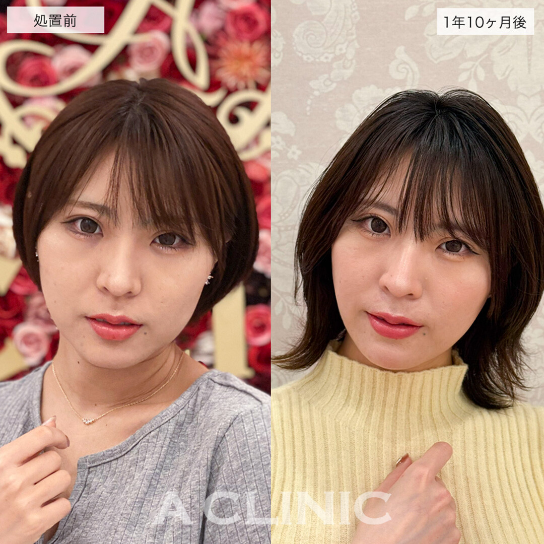 1day小顔脂肪吸引はリバウンドほぼ無しの半永久の小顔になれます!こちら処置前と1年10ヶ月後の症例です(20代女性)