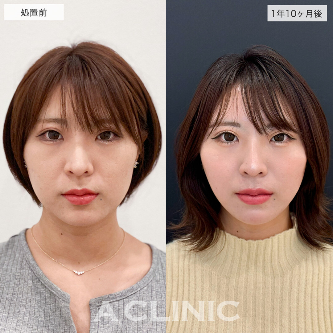 1day小顔脂肪吸引はリバウンドほぼ無しの半永久の小顔になれます!こちら処置前と1年10ヶ月後の症例です(20代女性)