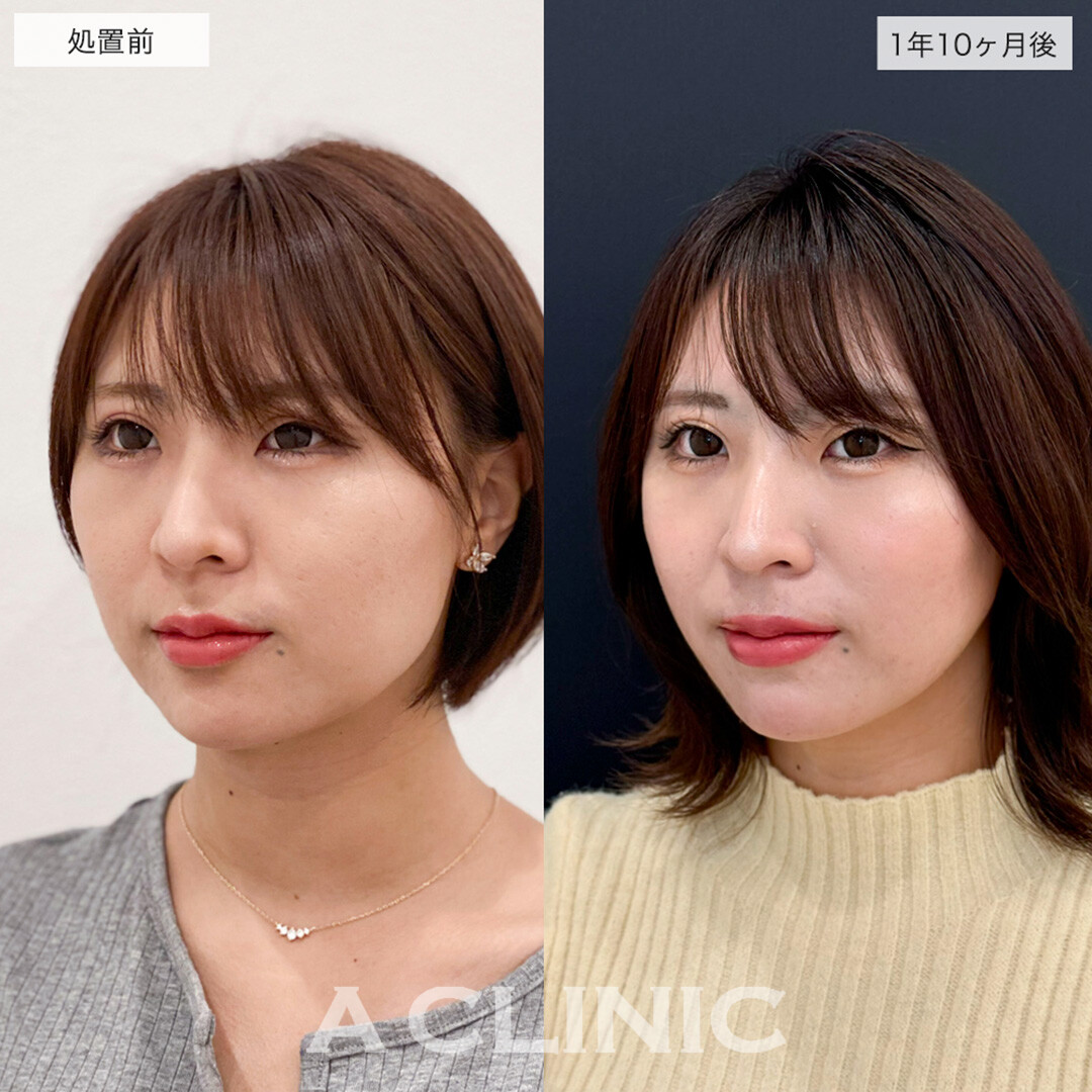 1day小顔脂肪吸引はリバウンドほぼ無しの半永久の小顔になれます!こちら処置前と1年10ヶ月後の症例です(20代女性)