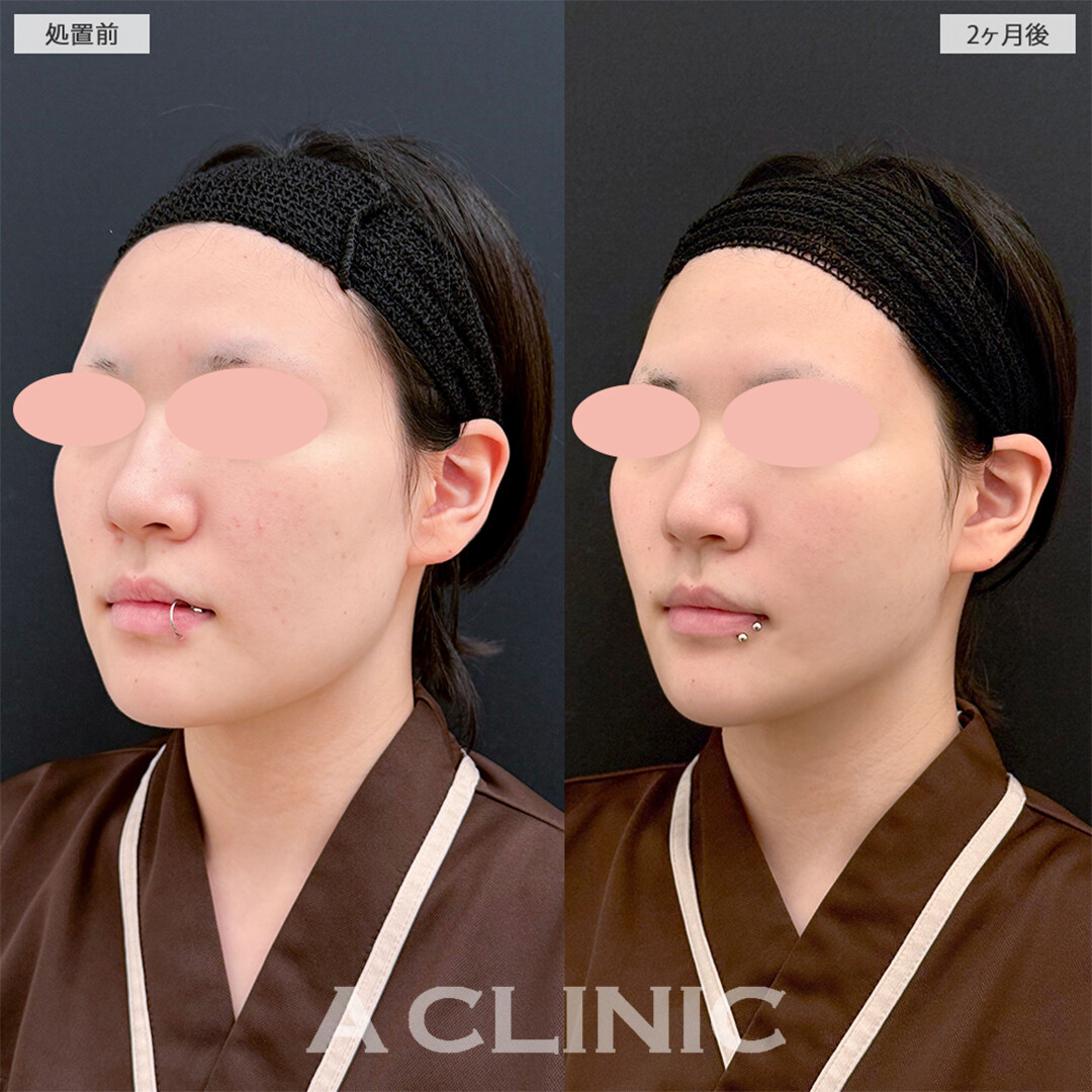 1day小顔脂肪吸引と小顔エラボトックスの組み合わせは小顔最強施術です！こちら処置前と2ヶ月後の症例です(10代女性)