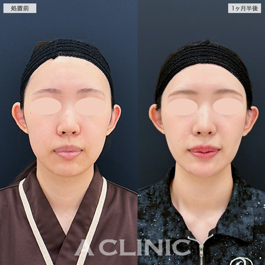 1day小顔脂肪吸引とヒアルロン酸注入の組み合わせで完璧な美Eラインへ!こちら処置前と1ヶ月半後の症例です(20代女性)