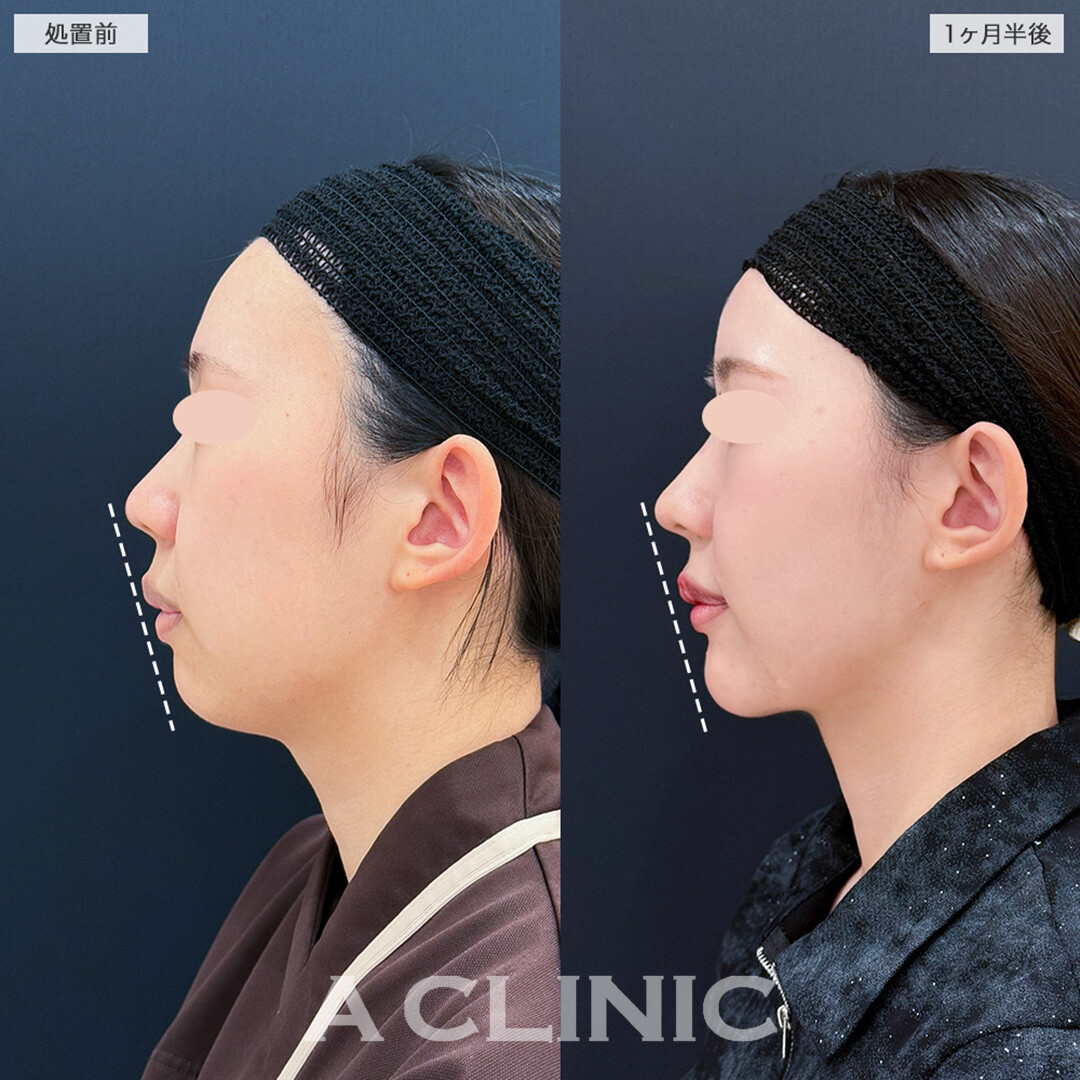1day小顔脂肪吸引とヒアルロン酸注入の組み合わせで完璧な美Eラインへ!こちら処置前と1ヶ月半後の症例です(20代女性)