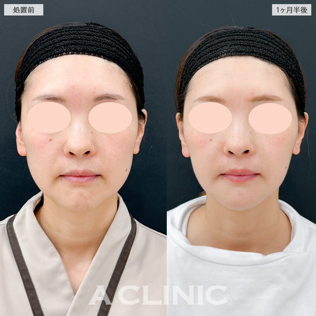 1day小顔脂肪吸引とほうれい線へのヒアルロン酸注射(シワ)で一気に若々しい印象に！処置前と1ヶ月半後の症例です(30代女性)